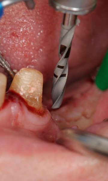 Implantes (1)