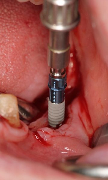 Implantes (2)