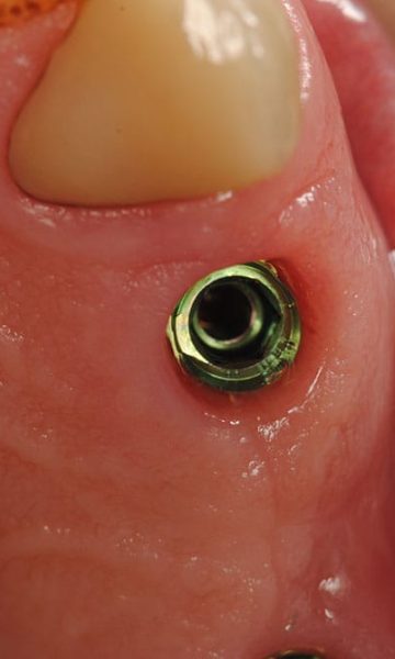 Implantes (3)