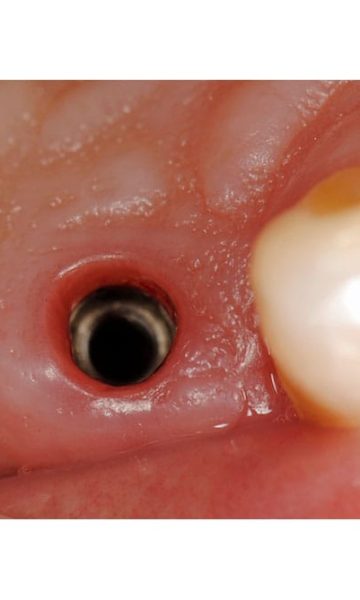 Implantes (4)