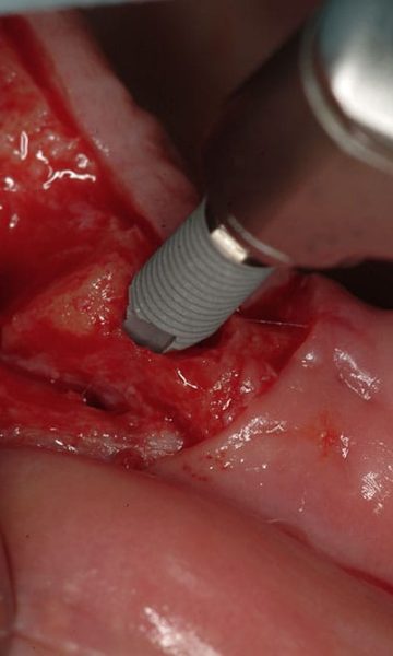 Implantes (5)