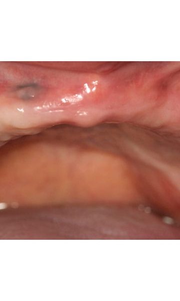 Implantes (6)
